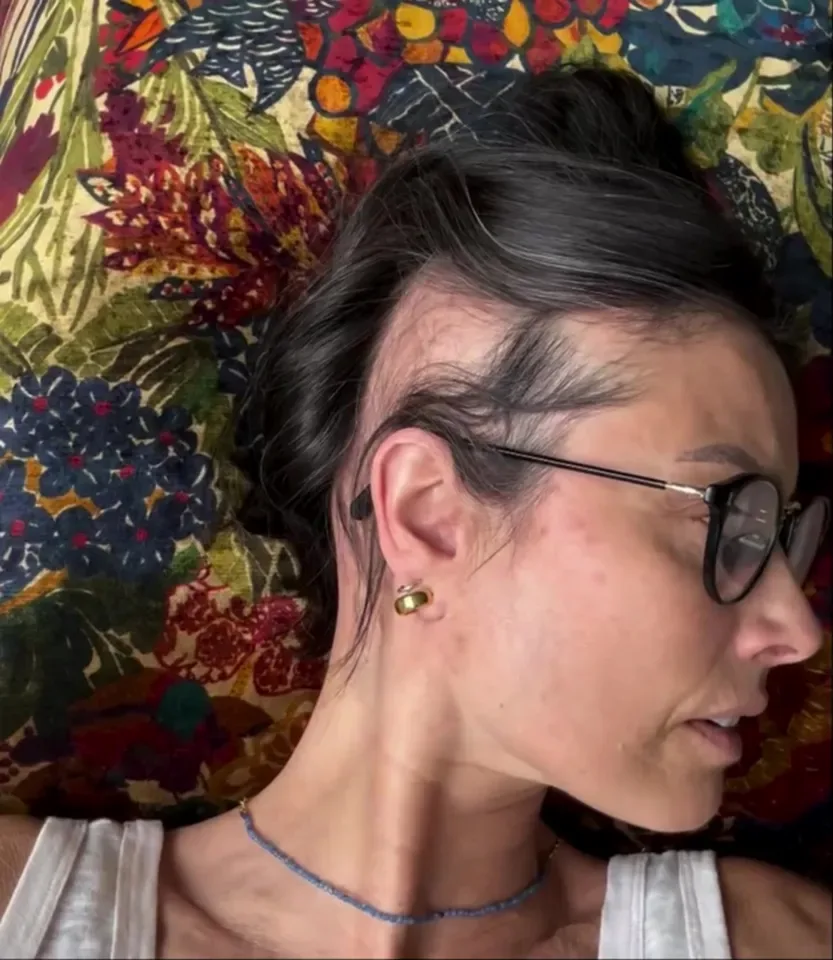Side profile of Melanie Sykes showing signs of hair loss due to alopecia.